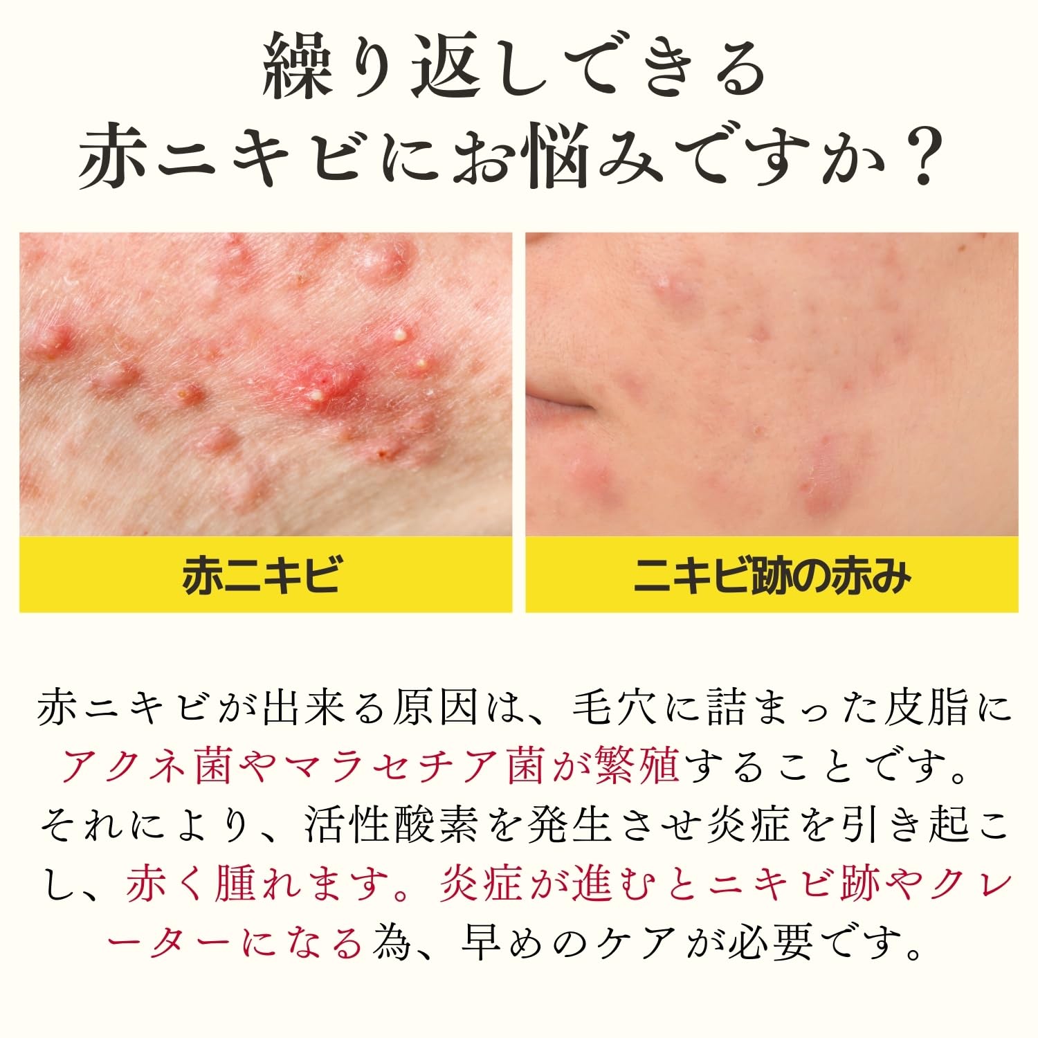 Doctor Re9 Berlian VC Lotion - Medicated Acne Care Hypoallergenic 80ml.