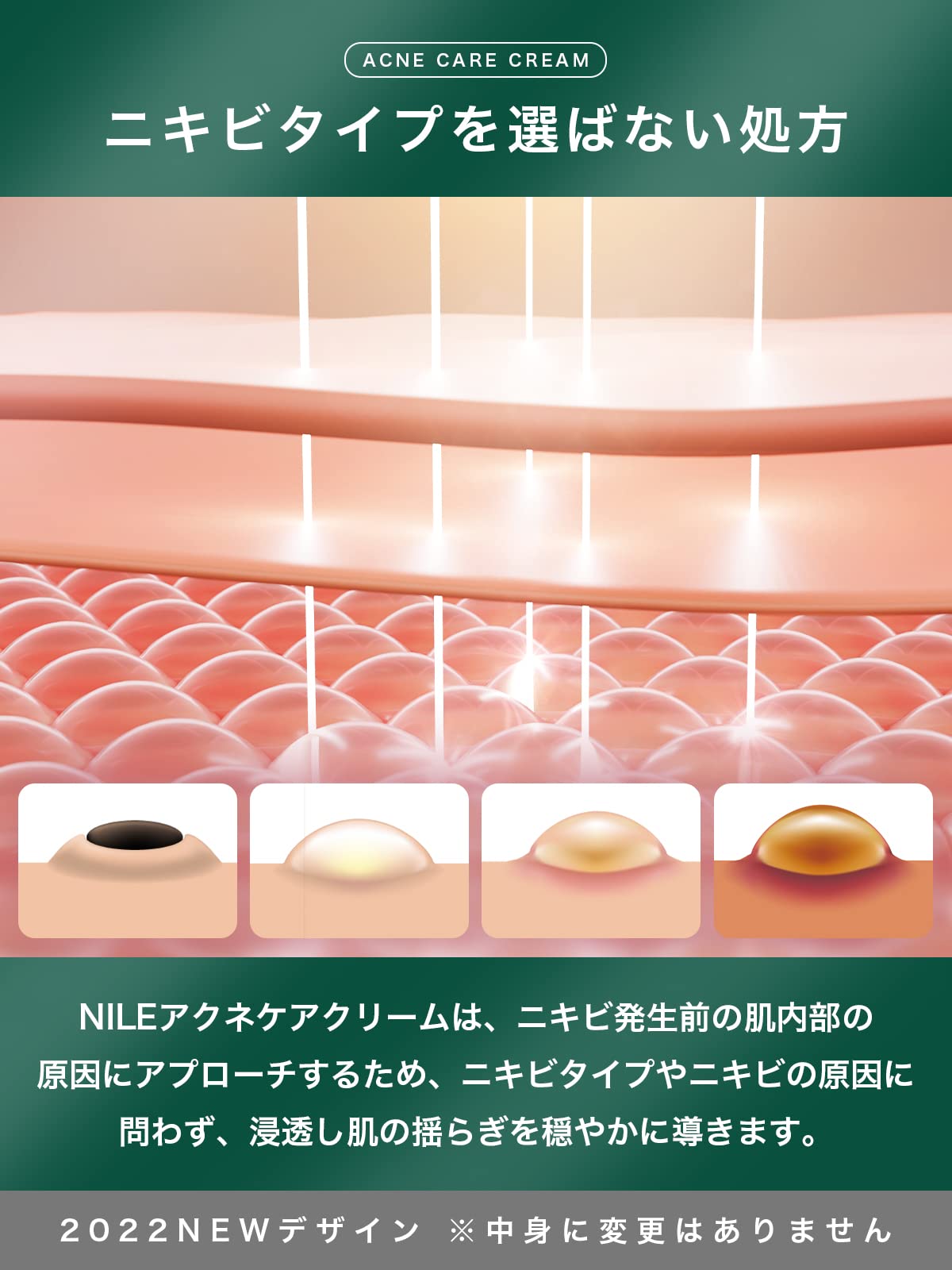 Nile Acne Cream Men'S Women'S After Sun Care Quasi Drug 50G