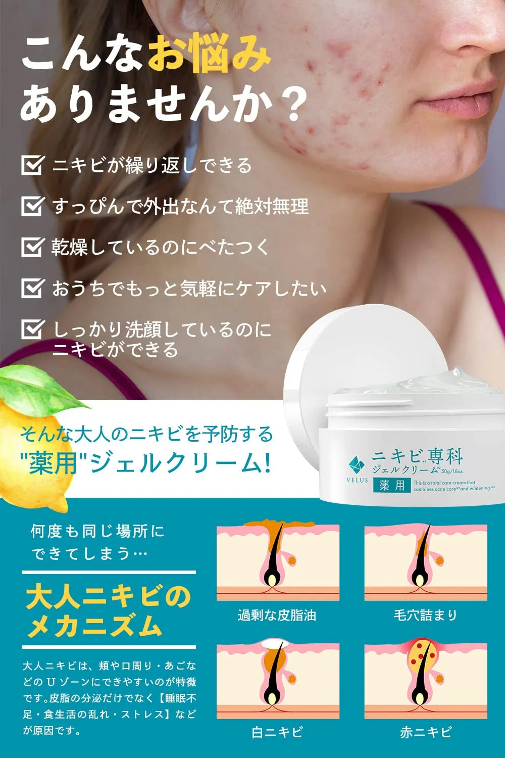 Velus Special Acne Care & Whitening Gel 50g - Acne Care Gel - Whitening Gel